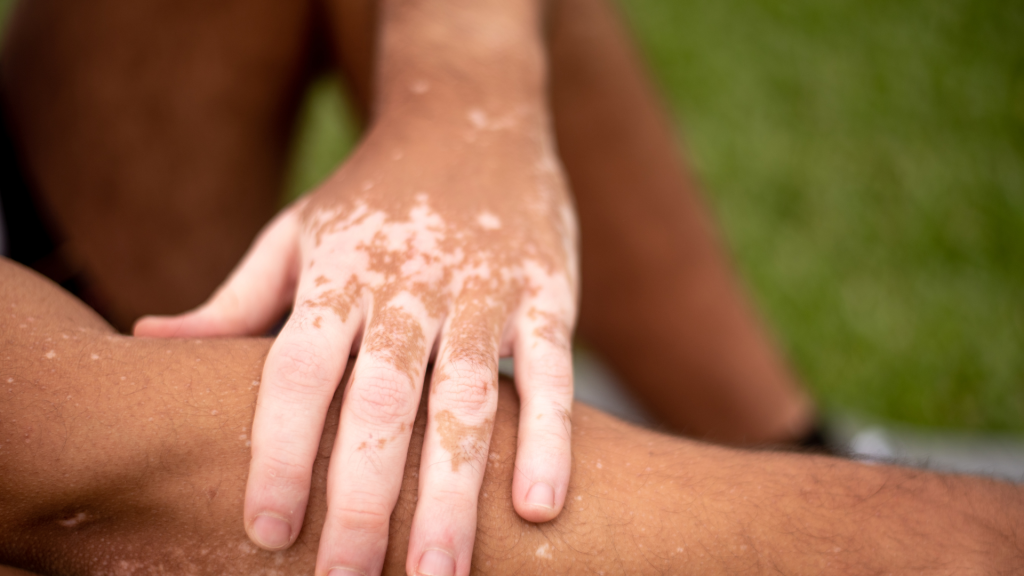 Mengenal Vitiligo: Penyebab, Perawatan, dan Cara Mencegah Penyebaran Bercak Putih pada Kulit 1 1 2