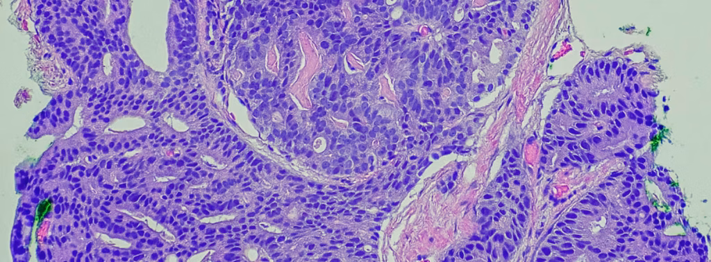 Peneliti Oxford Temukan Protein Darah yang Berkaitan dengan Risiko Kanker Prostat hingga 15 Tahun Sebelum Diagnosis
